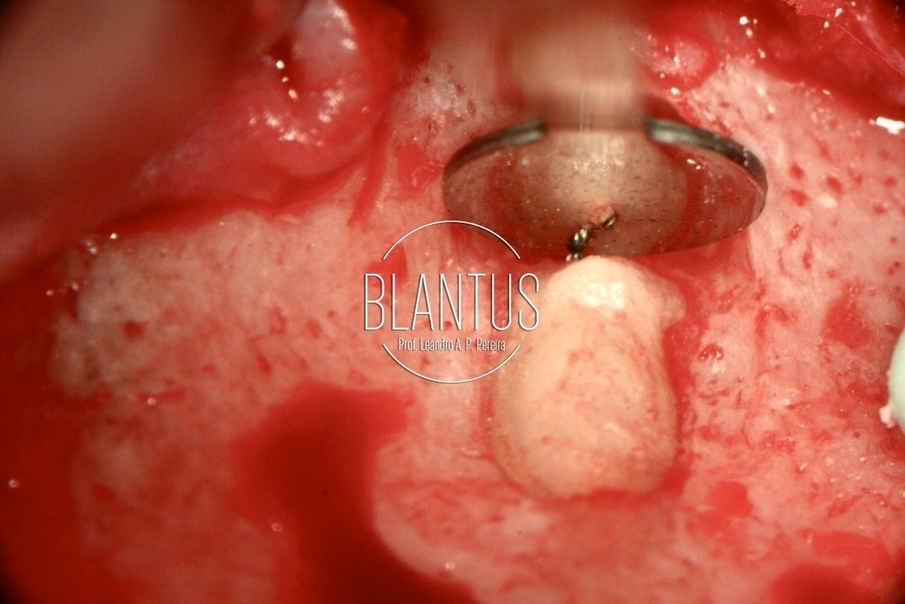 Microcirurgia Endodôntica Piezoelétrica para remoção de instrumento fraturado no ápice