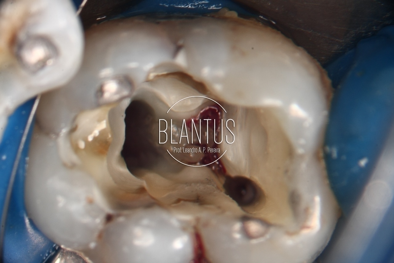 Tratamento endodôntico de molar inferior com 4 canais