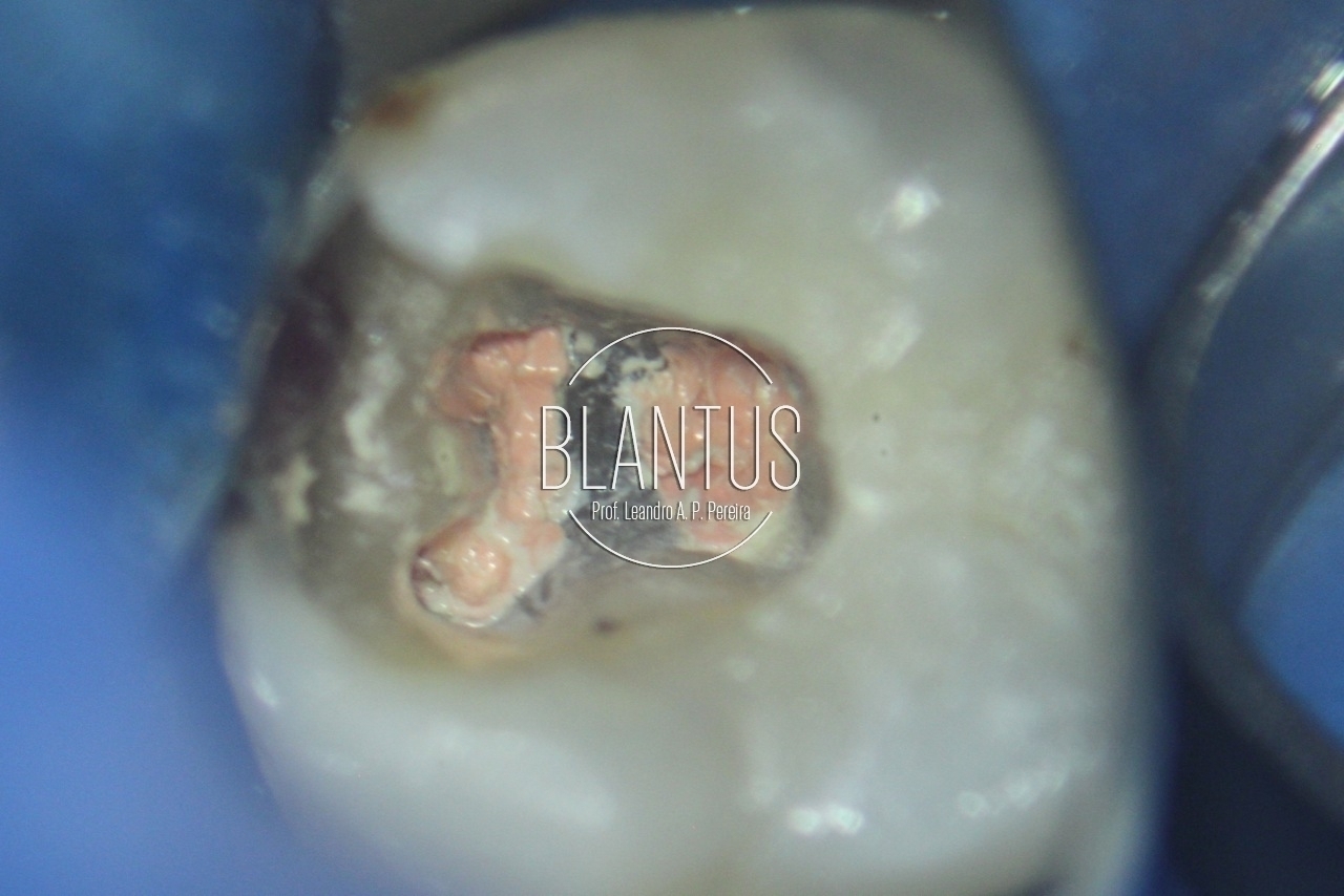 Endodontia dente 47 em sessão única com sedação inalatória