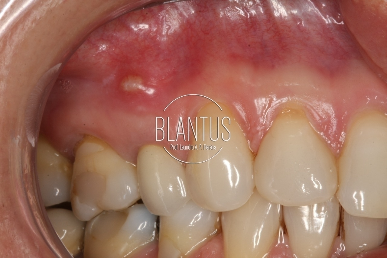 Microcirurgia Endodôntica Piezoelétrica