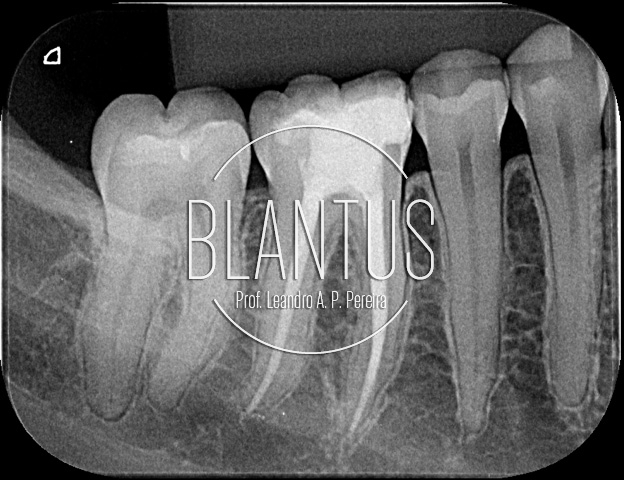 Endodontia em sessão única com sedação inalatória