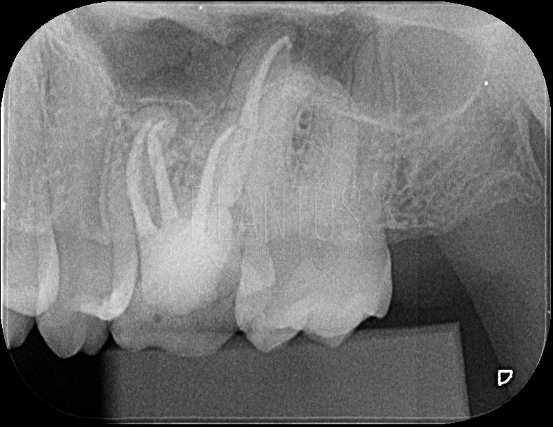 Reintervenção Endodôntica em Molar Superior com Curvatura