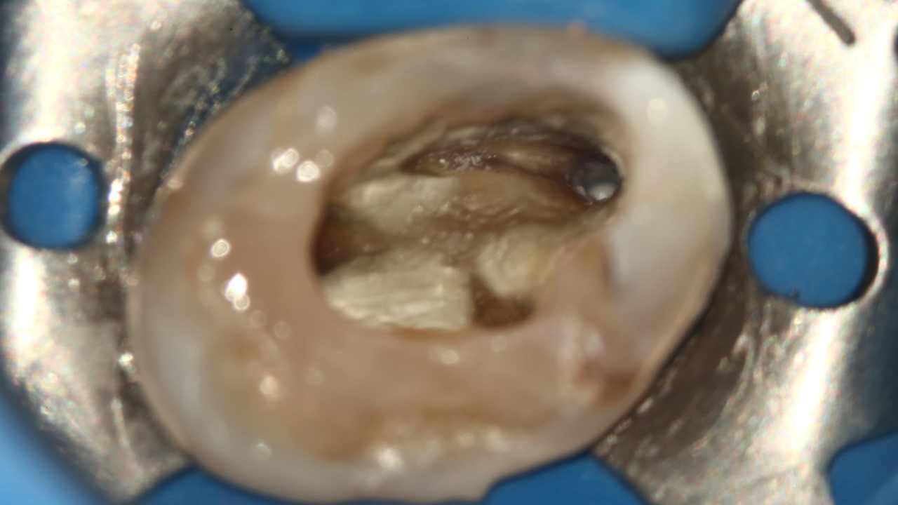 Ultrassom, Tomografia, Microscopia Operatória e Controle de Infecção Endodôntica