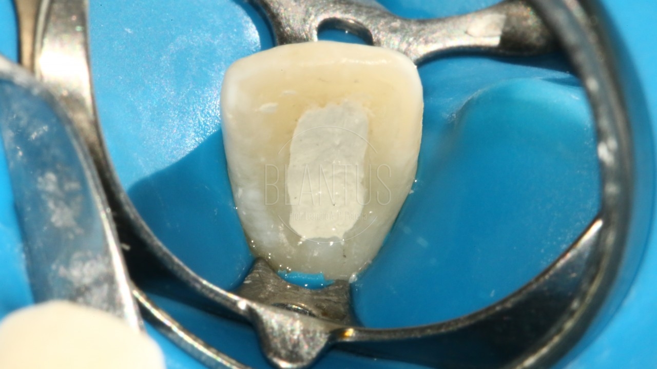 Uso do Biodentine em um Caso de Reabsorção Radicular