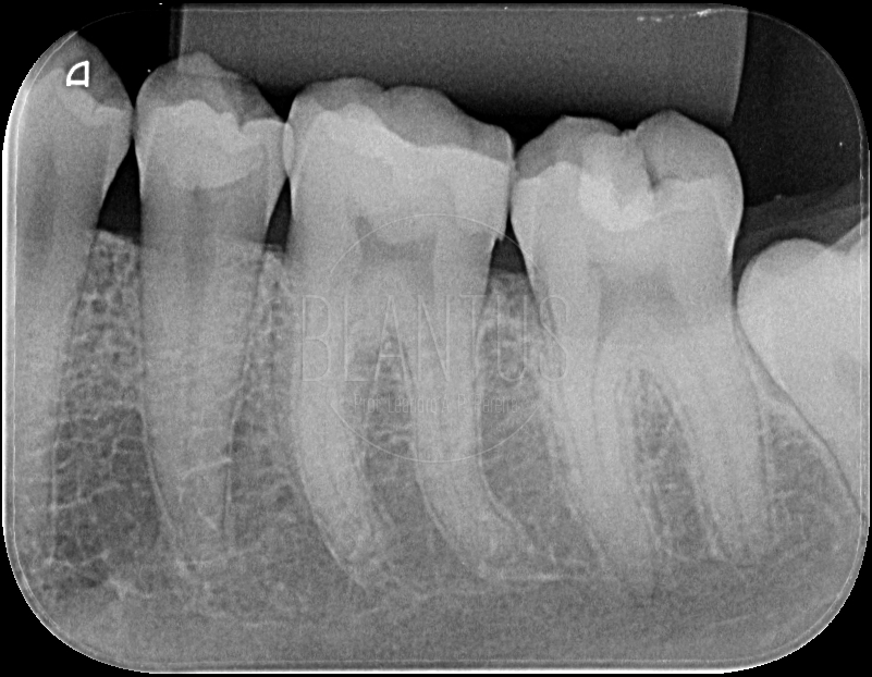 É possível anestesiar um molar inferior sem realizar bloqueio?