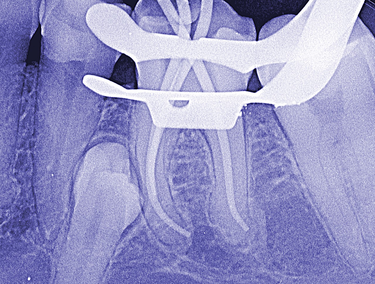 Curso Online de Preparo do Canal Radicular PROMOÇÃO ATÉ 17/03/19