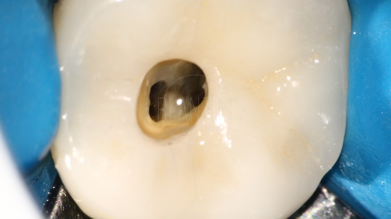 Tratamento Endodôntico de molar inferior com anatomia atípica