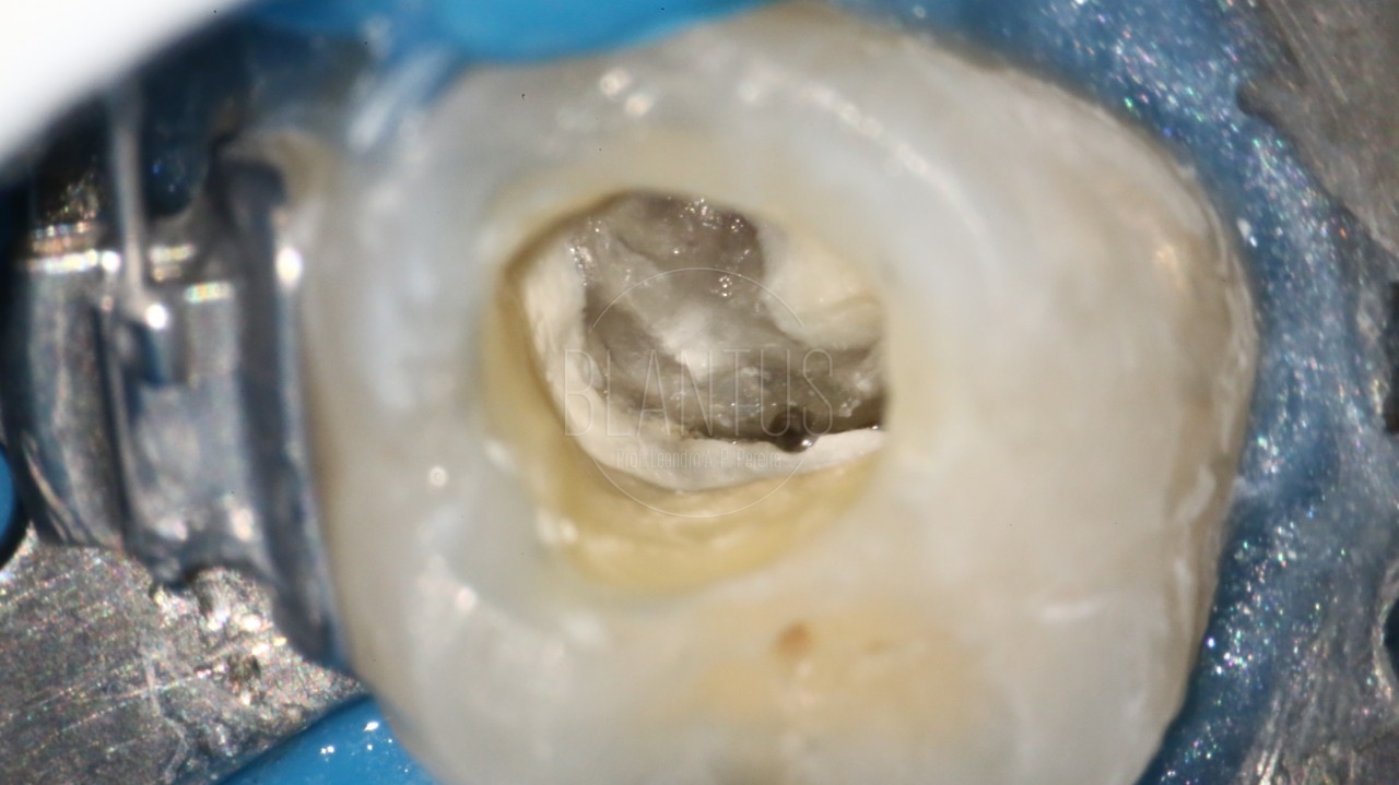 Tratamento endodôntico em dente de um Implantodontista
