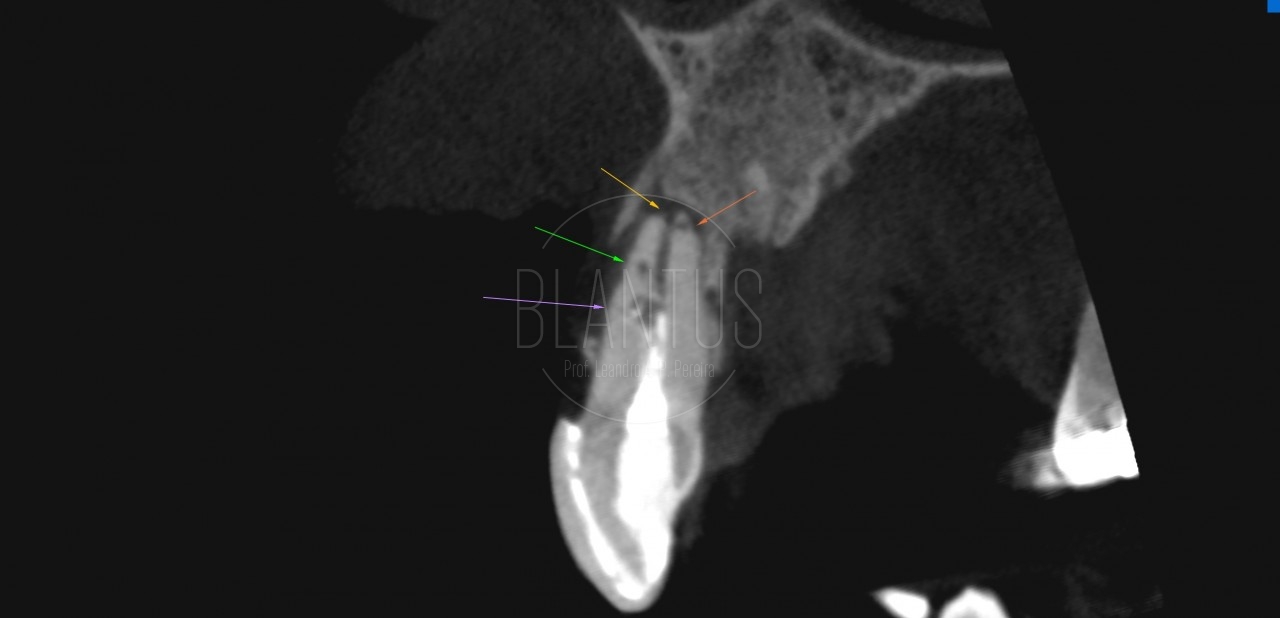 Anatomia de Incisivo Central nem sempre é simples.