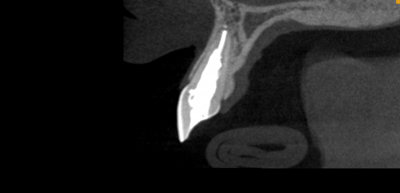 O desafio de realizar retratamento endodôntico em dentes com canais amplos.