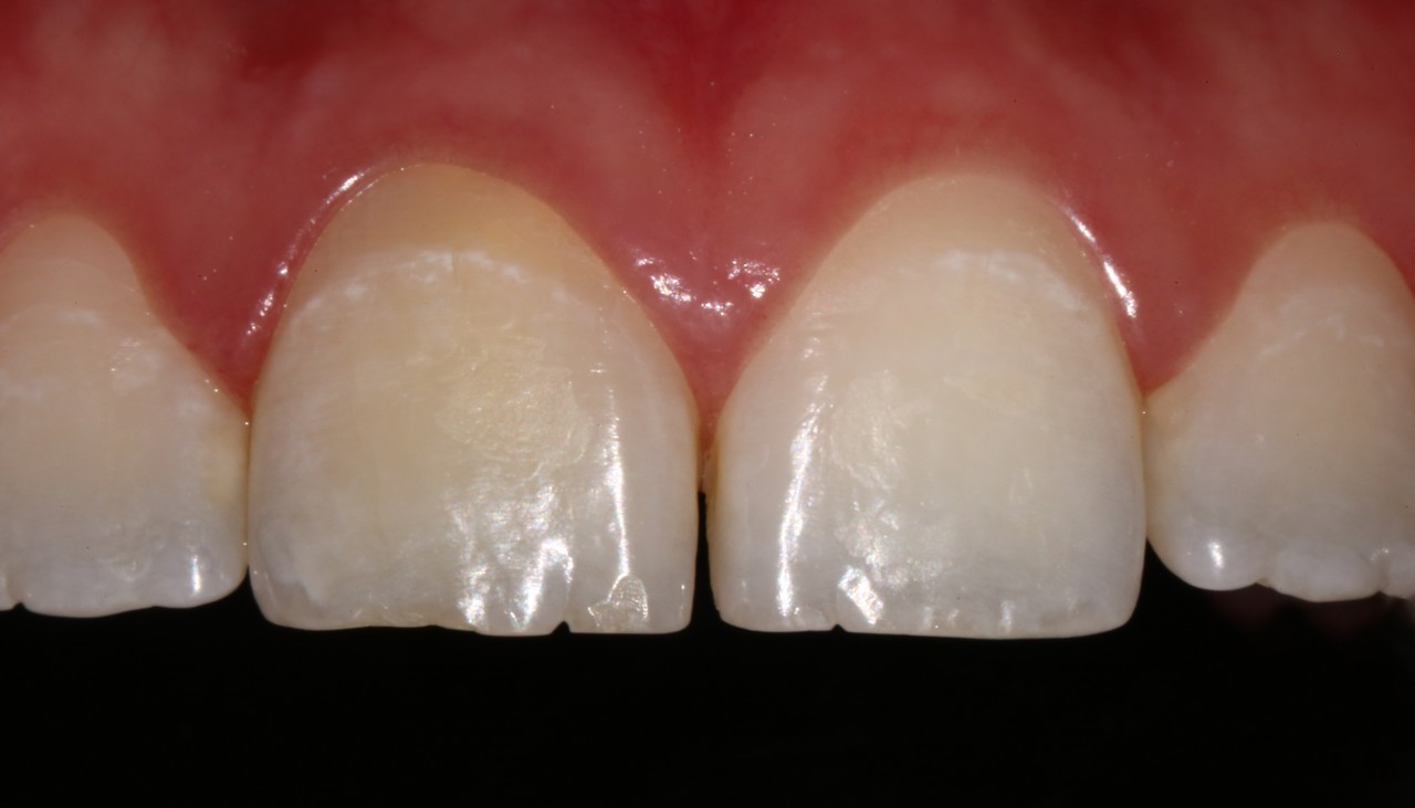 Tratamento Endodôntico (tratamento de canal) escurece o dente?