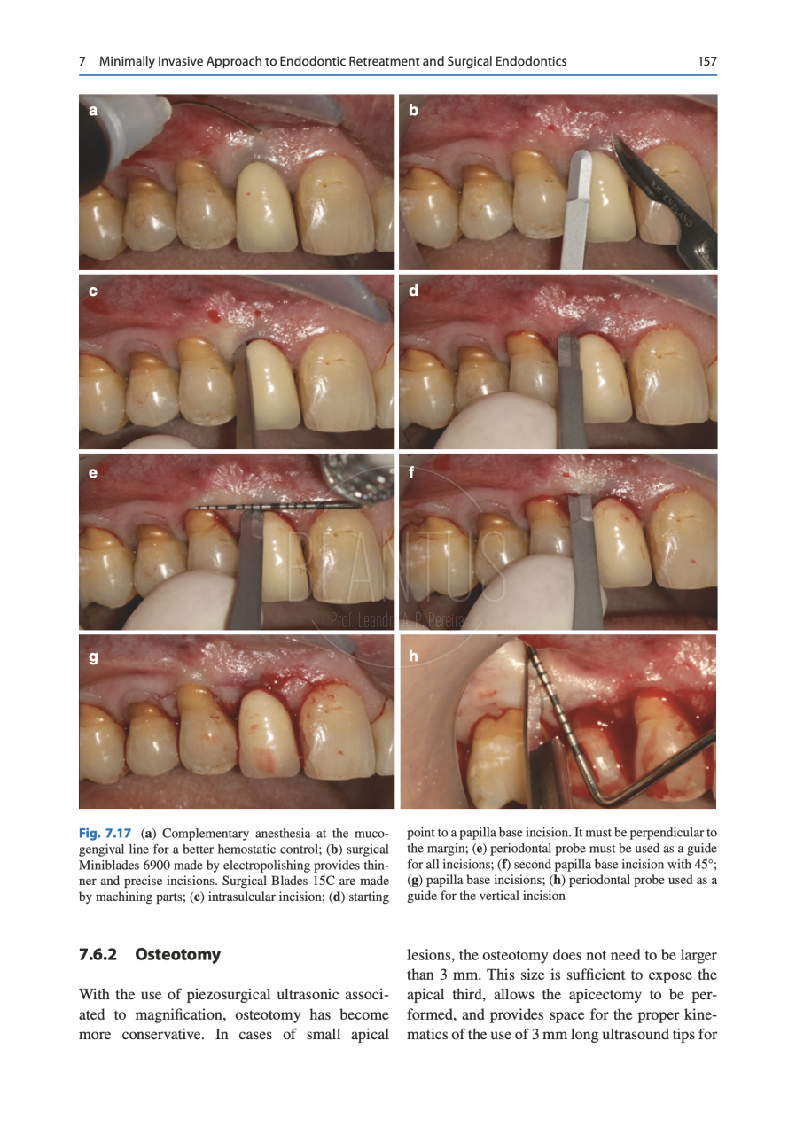 Mais um capítulo publicado em um livro internacional de Endodontia