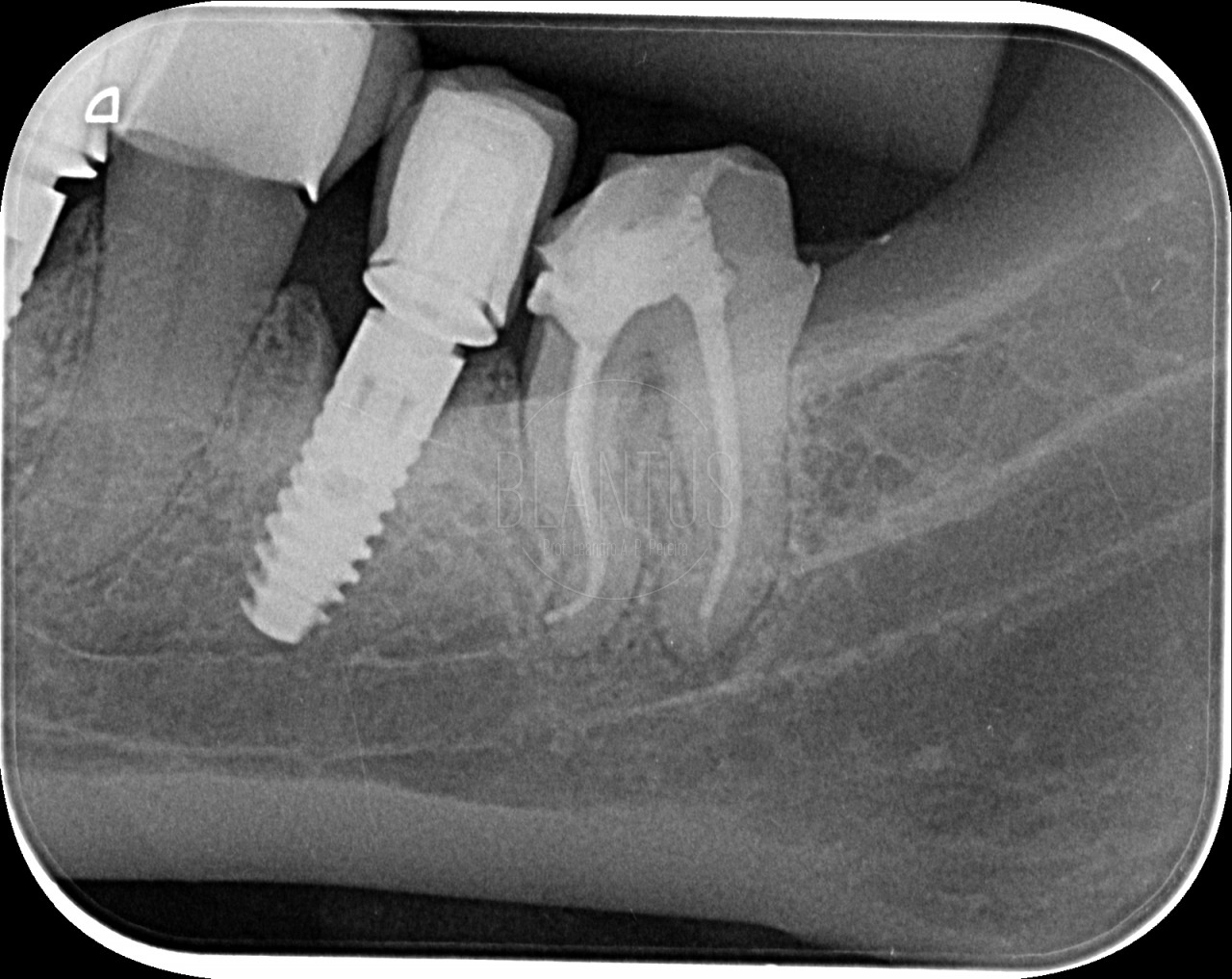 Molar inferior com múltiplas curvaturas